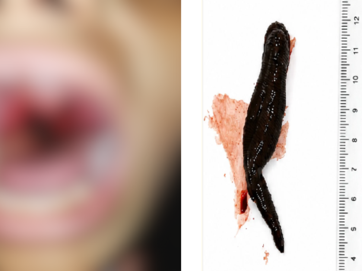 Menina de 12 anos tem sanguessuga de 8 cm removida da garganta após beber água de riacho