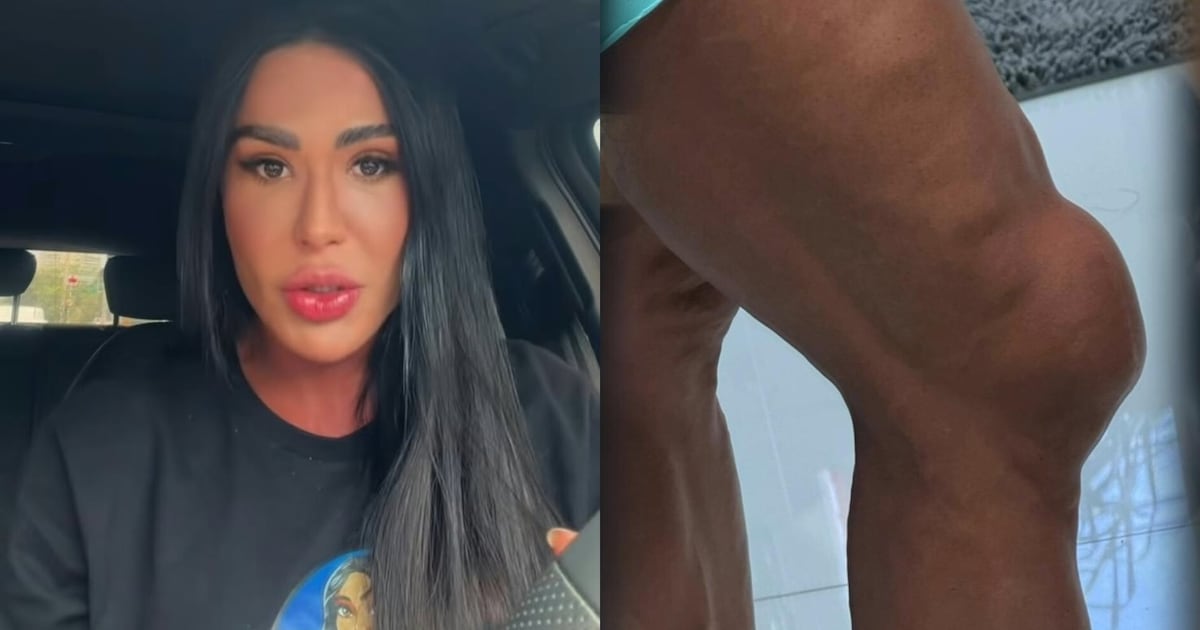 Gracyanne Barbosa explica motivo de joelho inchado que deixou fãs assustados