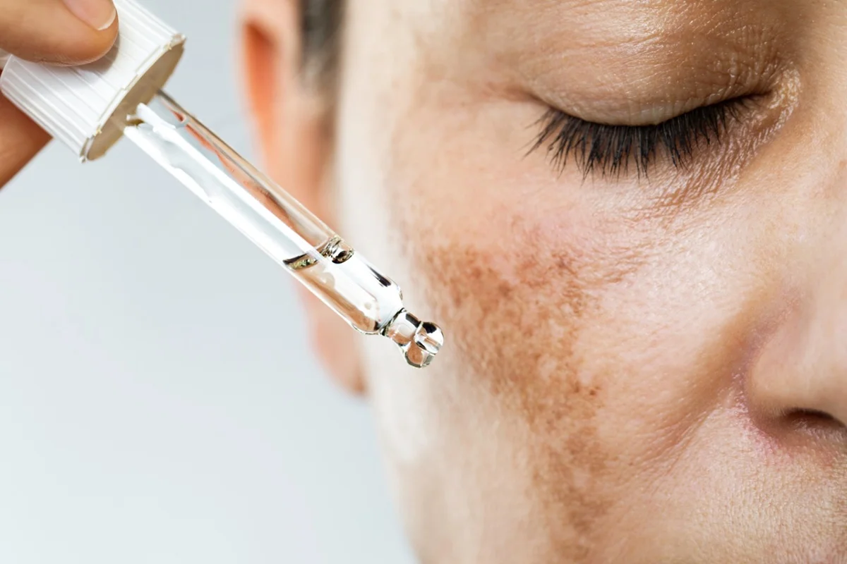 Melasma: saiba diferenciar os 3 tipos da doença e a melhor forma de tratar